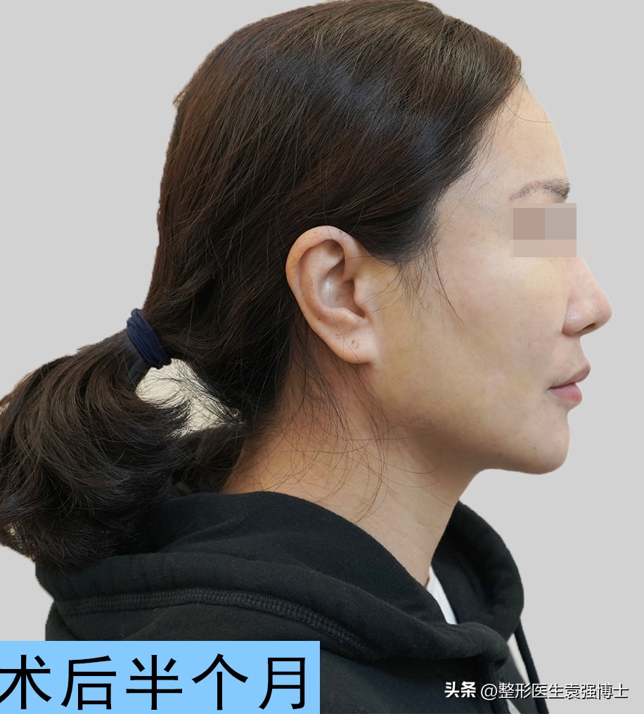 44岁女士拉皮除皱,50岁女人面部拉皮