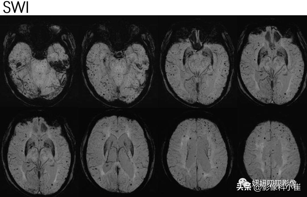 脑部肿瘤疾病有哪些,脑部有病变但是不是肿瘤