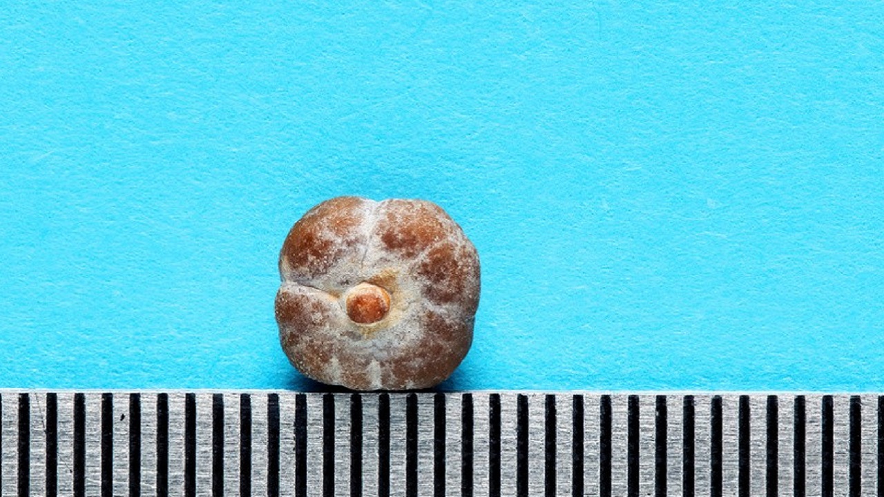 体检查出了肾结石怎么办,体检查出肾结石要不要治疗