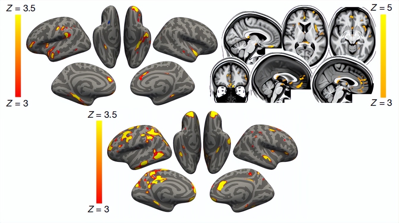 轻型新冠对大脑的影响,新冠引起青少年大脑衰老