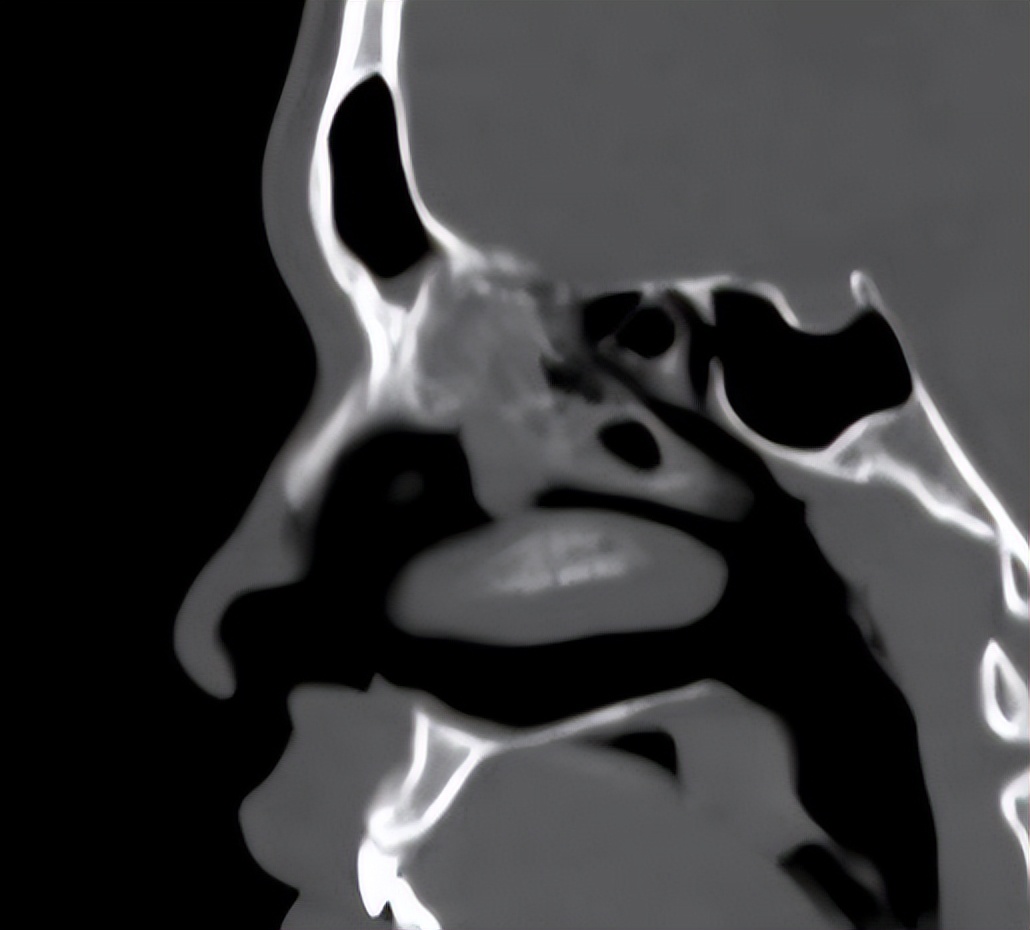 反复鼻塞,好不了,这次总算找到了原因