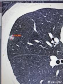 “就信戴主任，火速做完手术”，肺磨玻璃结节妹子术后还愿贴