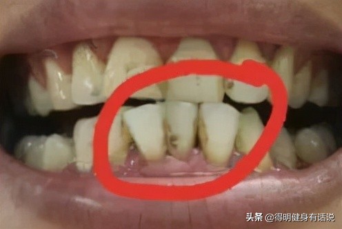 牙齿快暴露牙本质了怎么修复,牙齿已经露出牙本质了怎么修复