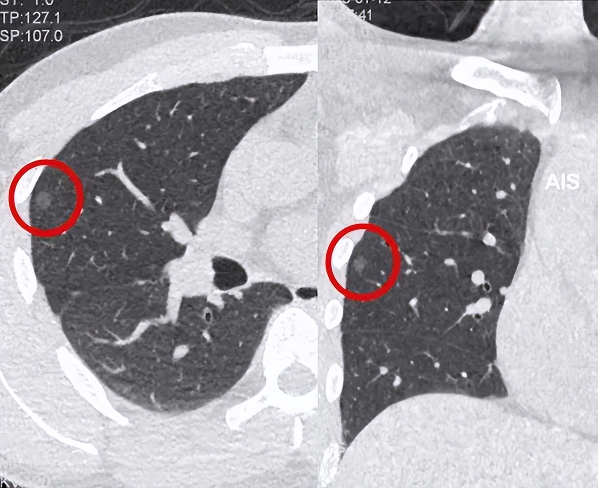 大蒜对肺结节有影响吗,大蒜配什么药治肺结节