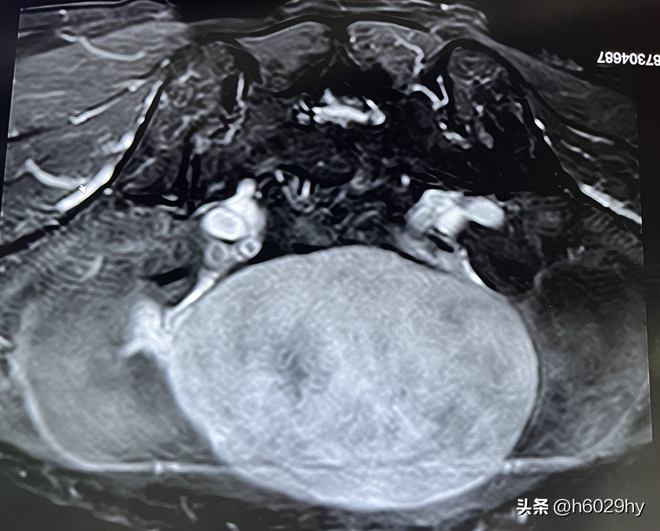 如何预防卵巢变小,卵巢切除可以预防乳腺肿瘤吗