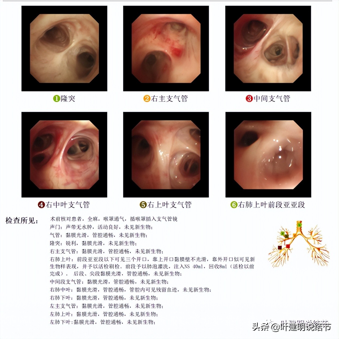 经验：肺占位超6厘米，不是癌还会是什么？临床上仍得多个心眼