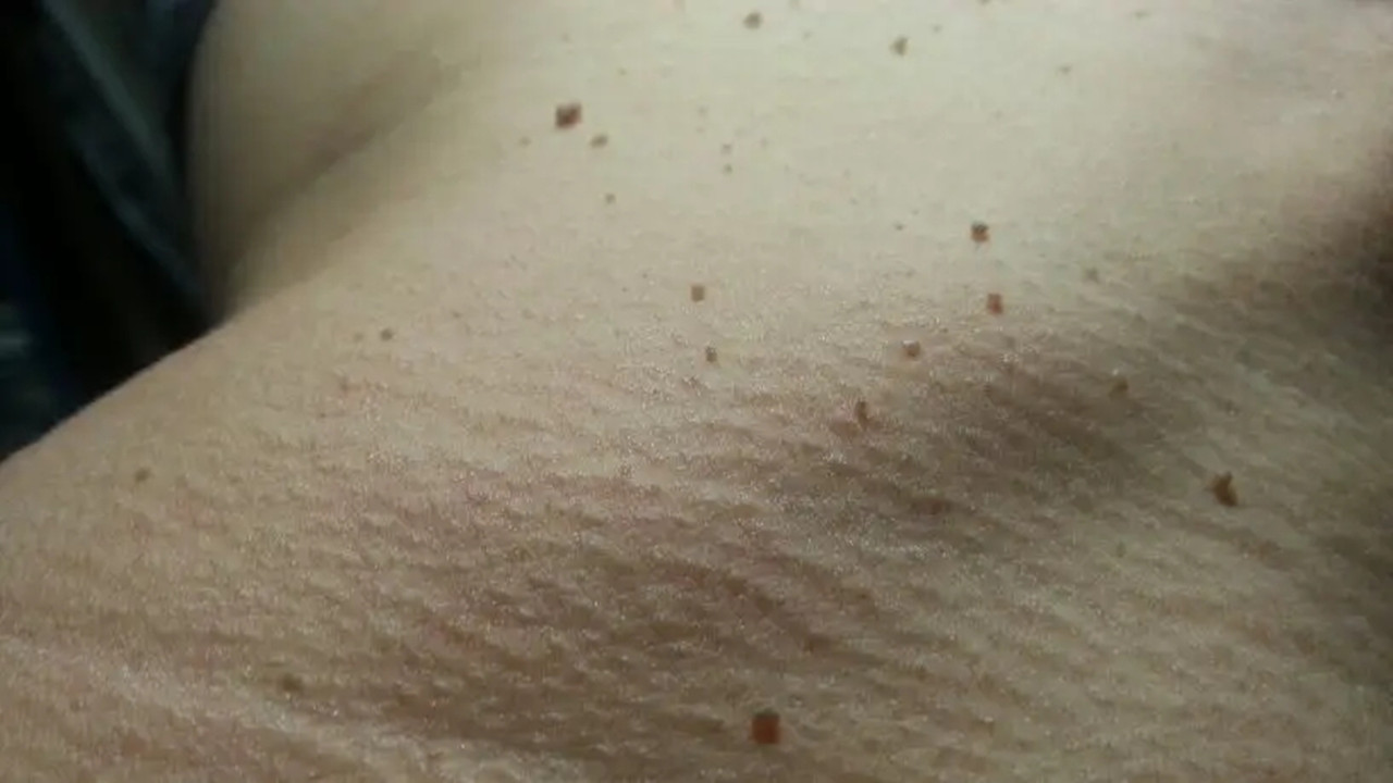 脸上、颈部、腋下的“肉疙瘩”是如何产生的？能用手抠掉吗？