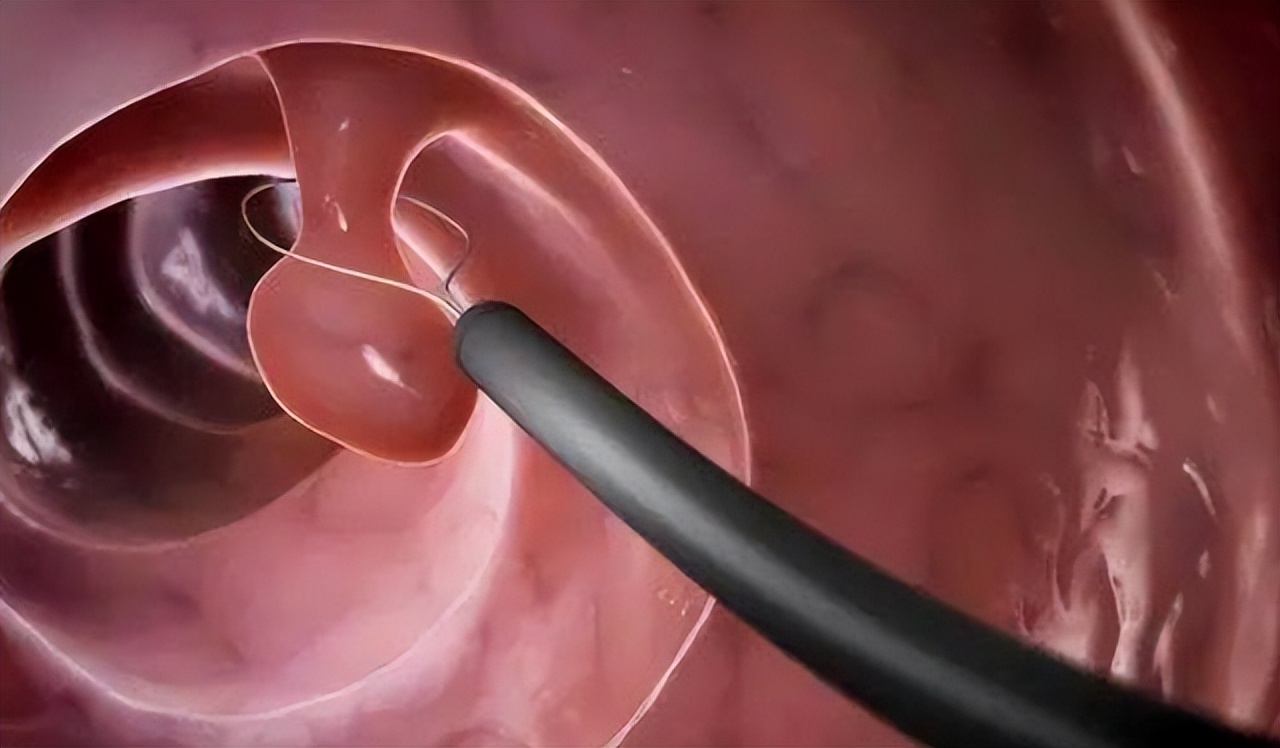 大便总有拉不干净的感觉何原因,大便总有拉不干净的感觉