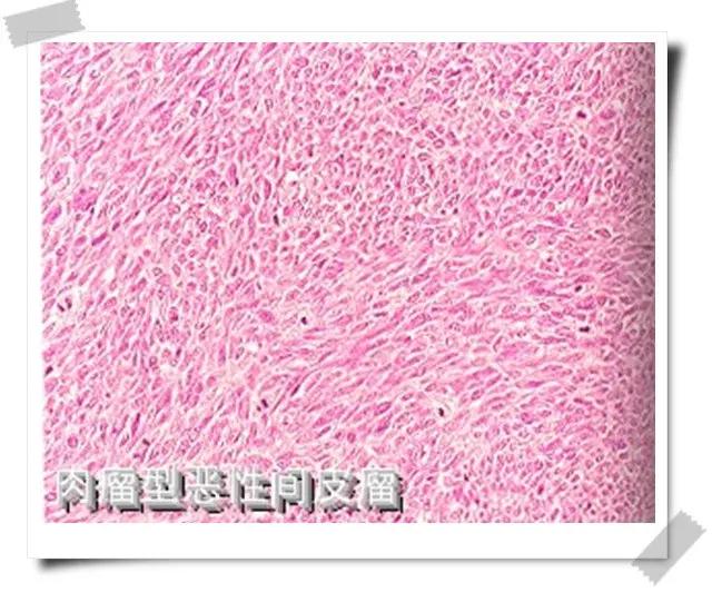 68岁老人腹胀，确诊1个月后去世，家属大哭：天堂的儿子太想妈妈