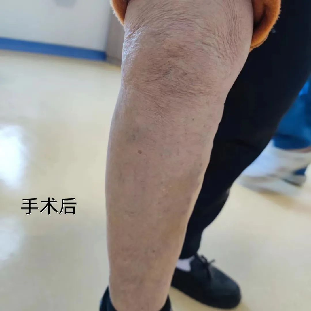 静脉曲张微创是打硬化剂么,可视微创治疗静脉曲张