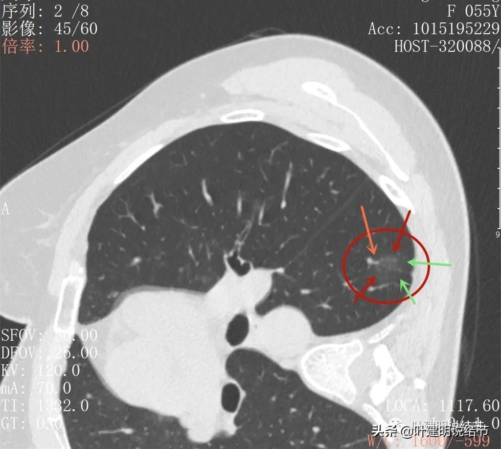 病例分享：这种样子的错构瘤？我是第一次见