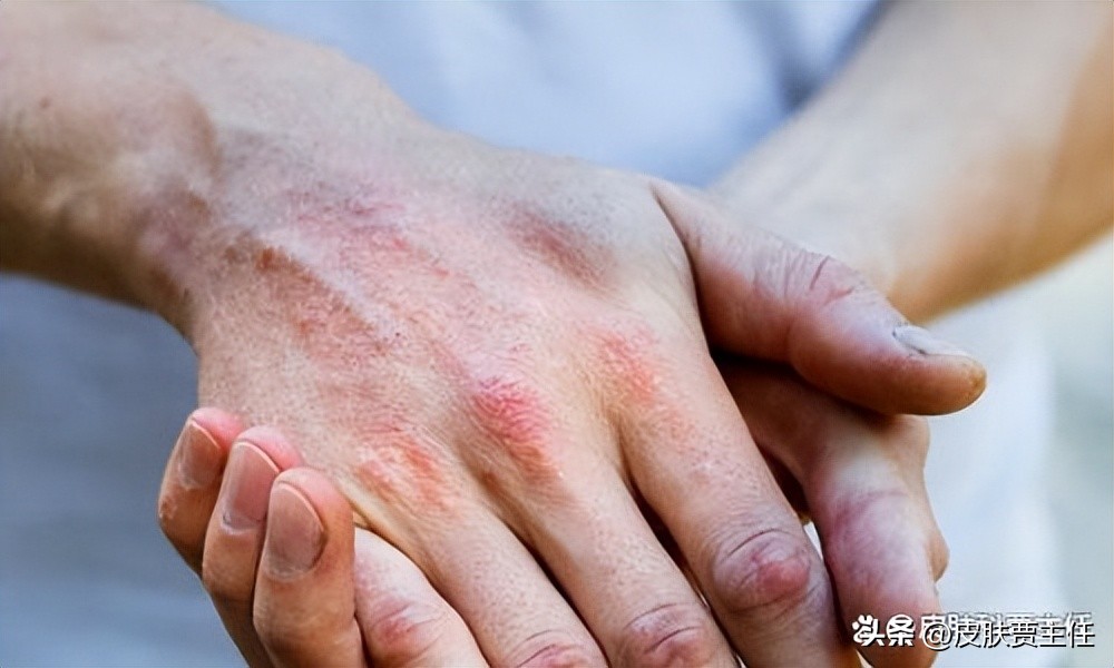 读完这篇文章，让你知道银屑病到底是什么，如何科学地来治疗