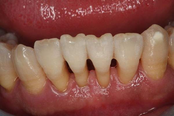 牙齿敏感用什么方法能解决,牙齿敏感快速解决方法