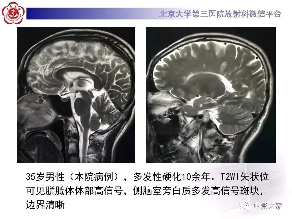 什么叫原发性胼胝体变性,原发性胼胝体变性治疗多少钱