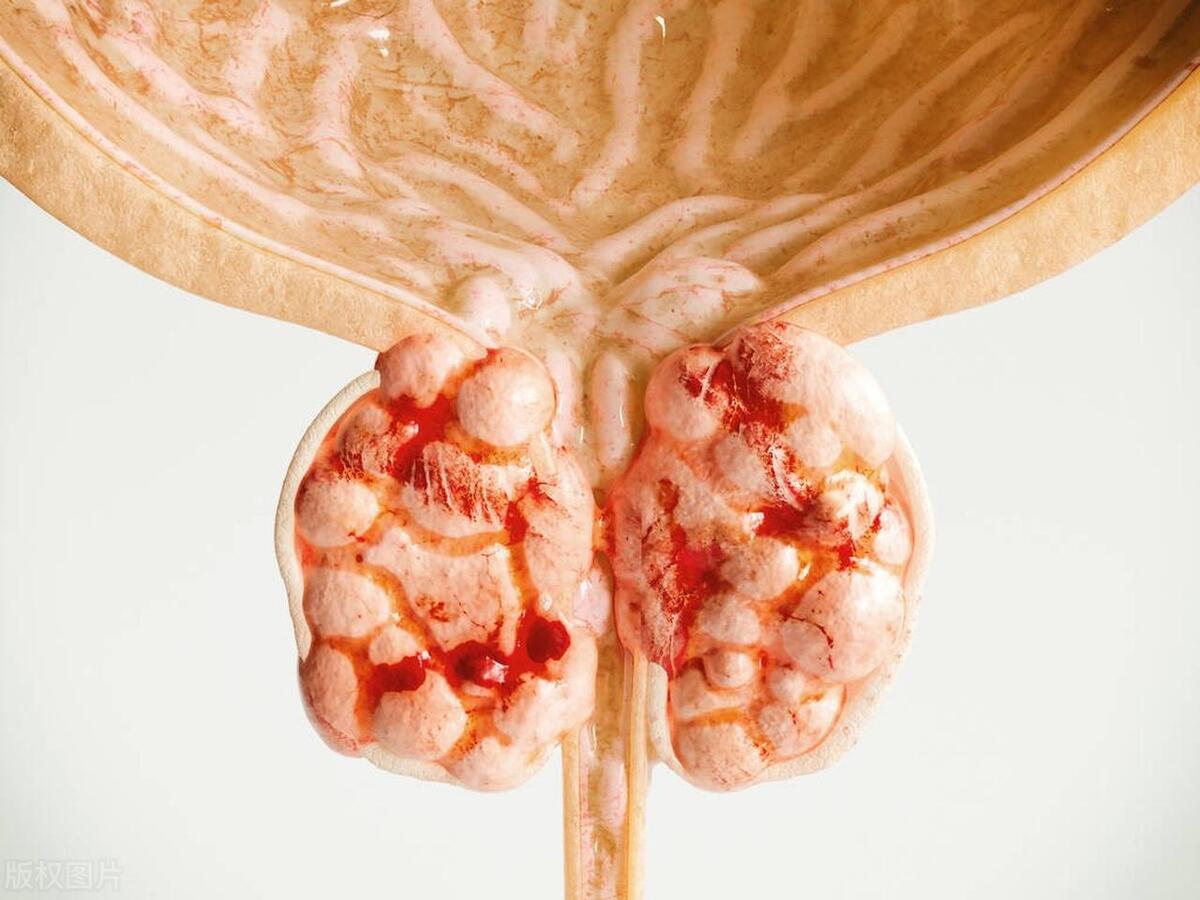 前列腺癌晚期骨转移怎么治,前列腺癌晚期骨转移首选治疗方法