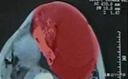 走近科学怀孕男子,重庆男子意外怀孕之谜