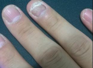 街边修脚店包治灰指甲，可信吗？