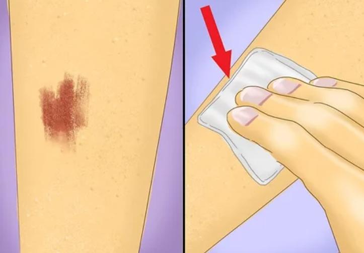 被擦伤了如何快速恢复,怎样护理伤疤