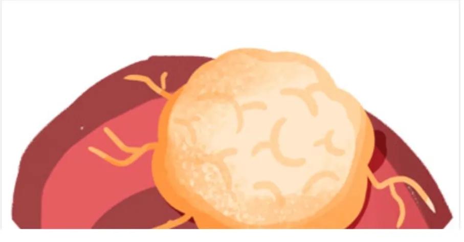 癌症诊断：县医院病理为基底细胞癌，省三甲结合免疫组化为良性瘤