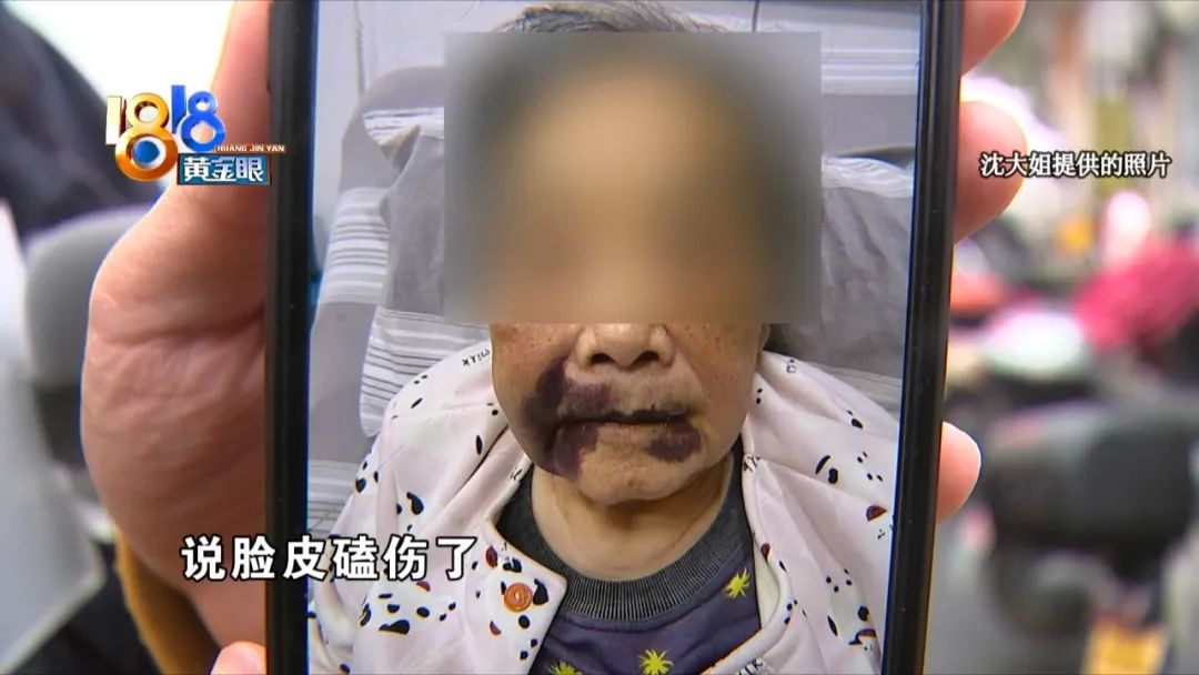 老年人身体有不明淤青,老人脸上出现淤青怎么回事