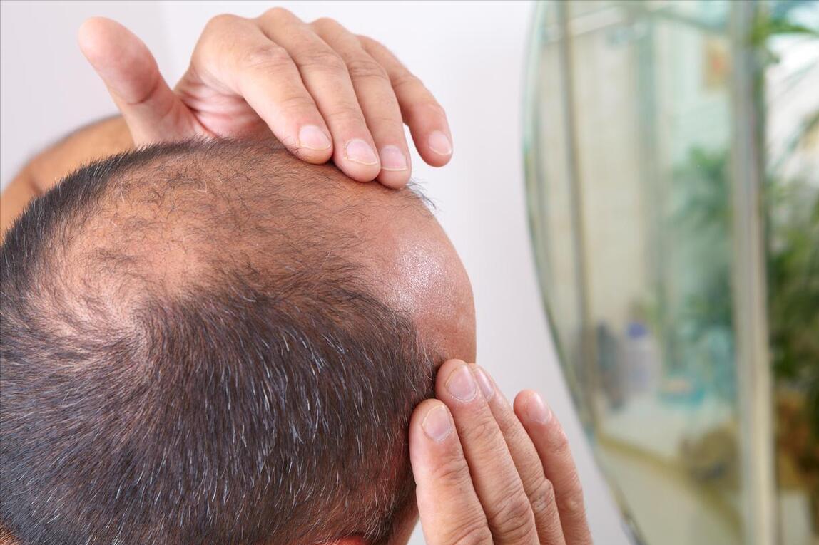 治疗脱发男女通用的药物,男女治疗脱发一样吗