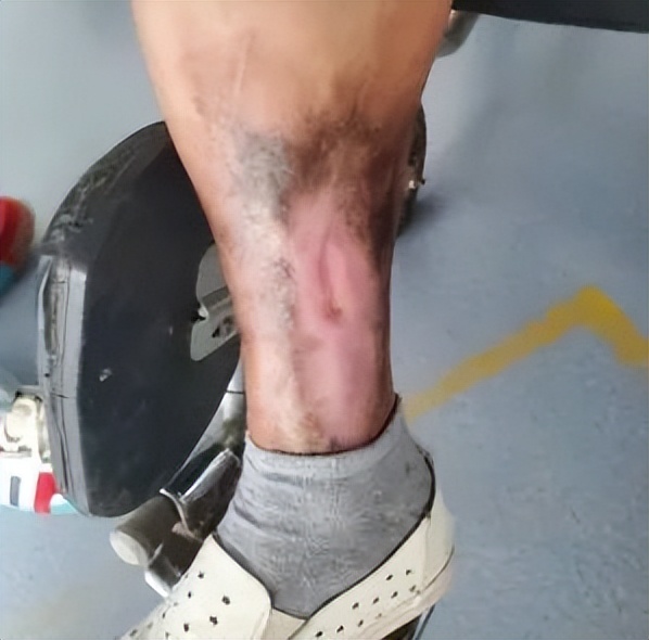 多科室合作救治,多管齐下抗击病魔