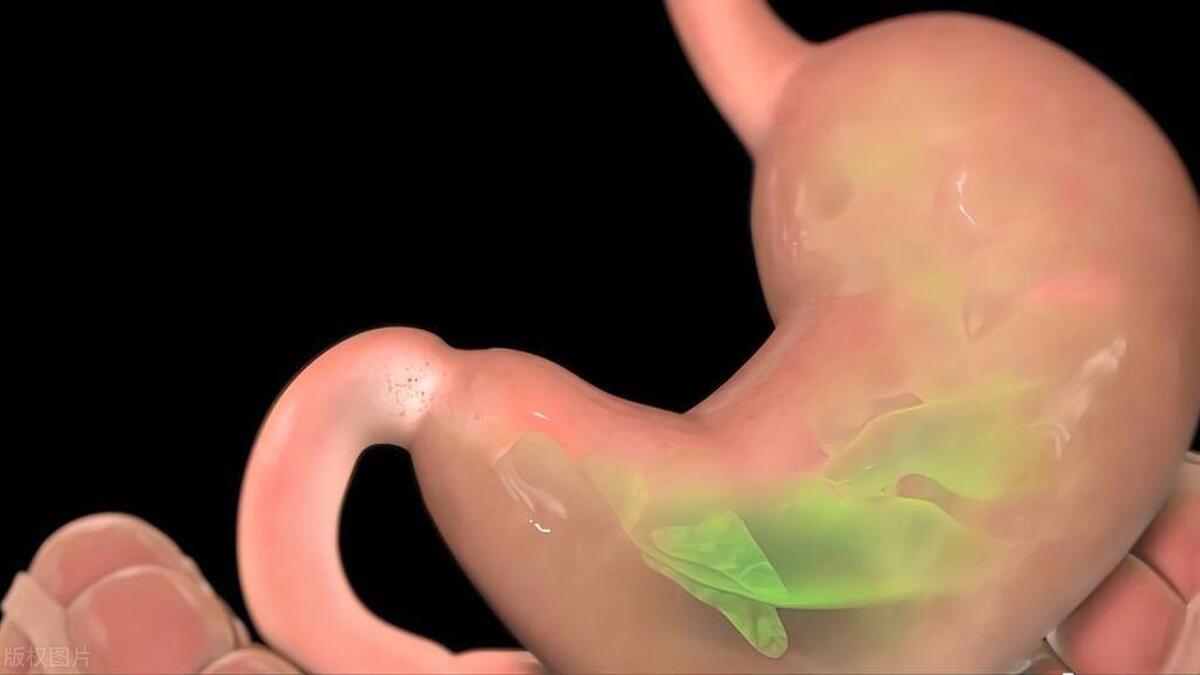 胃酸反流烧心吃什么,胃酸反流烧心反复怎么恢复