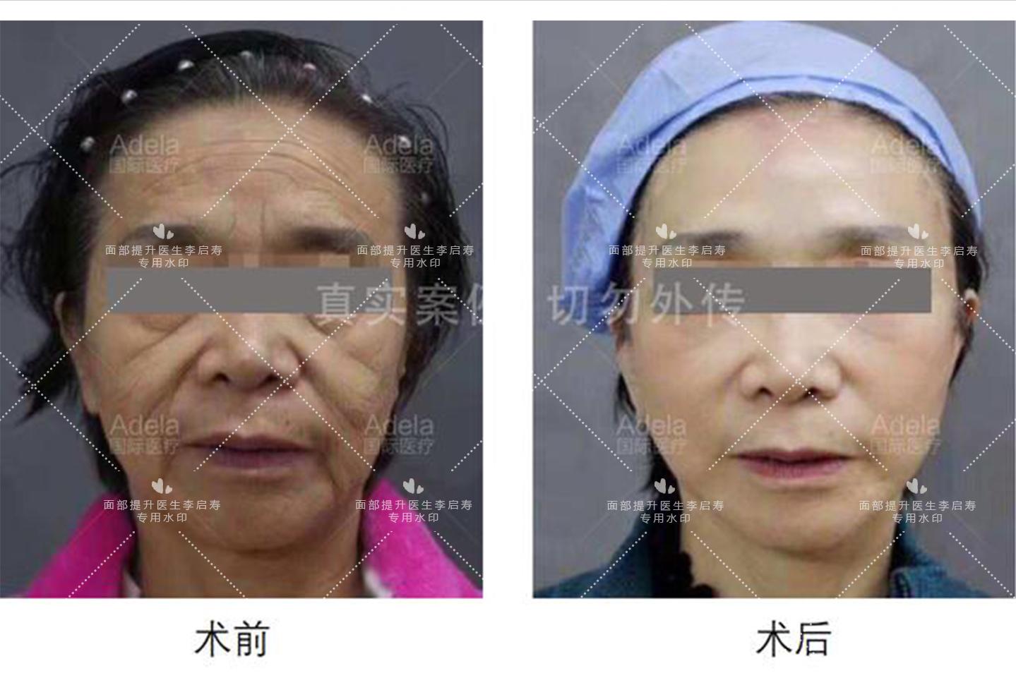 面部提升整形失败如何修复,面部提升年轻化术真实案例