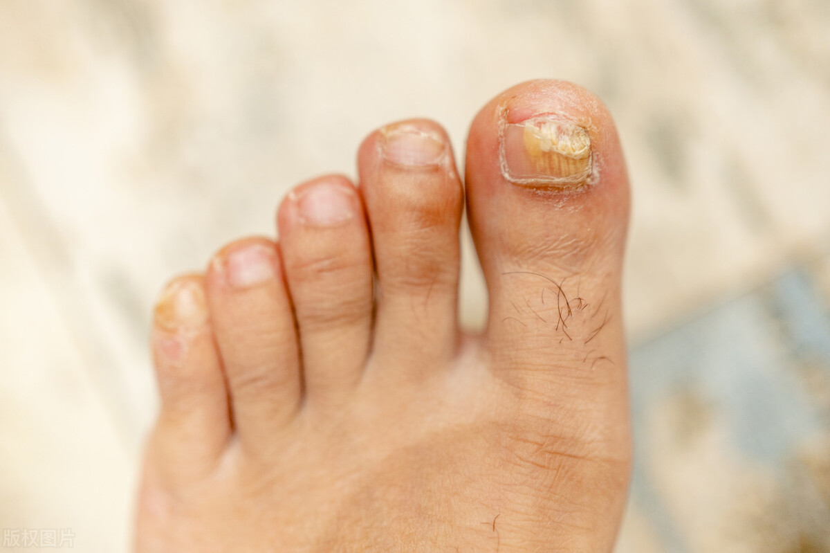 灰指甲能彻底治好吗,有没有人彻底治愈了灰指甲