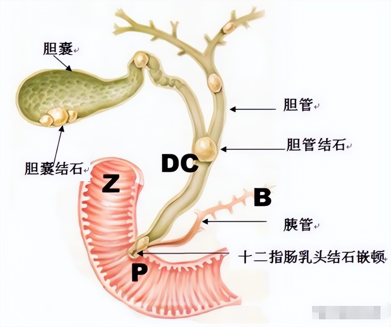 ercp手术后胆管发炎,化脓性胆管炎指南