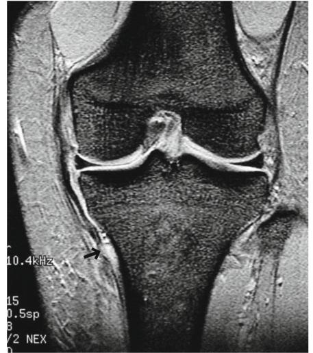 mcl内侧副韧带,内侧副韧带部分撕裂稳定性