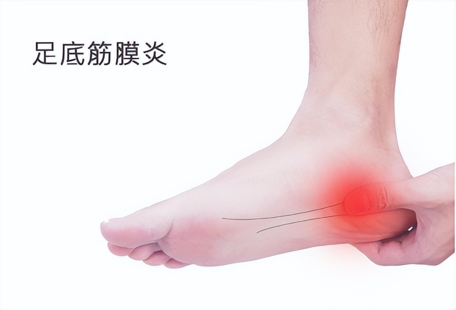 足底筋膜炎跑步会导致足弓痛吗,足底筋膜炎穿什么鞋跑步
