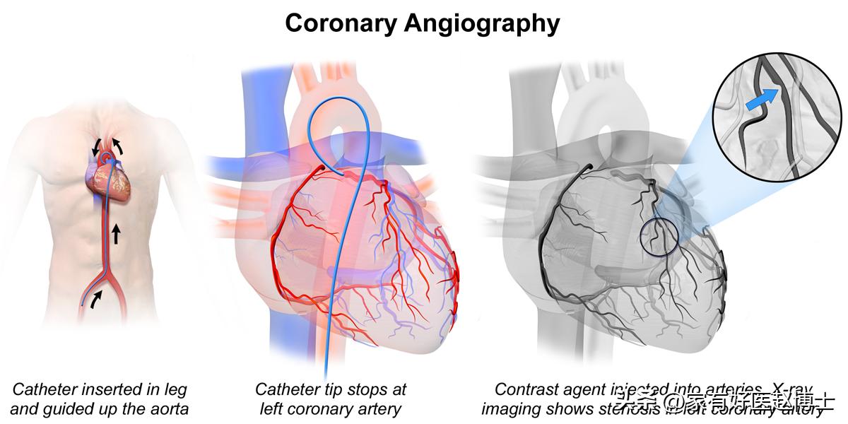 体检提示心血管局部钙化,体检发现冠脉见钙化影是什么意思