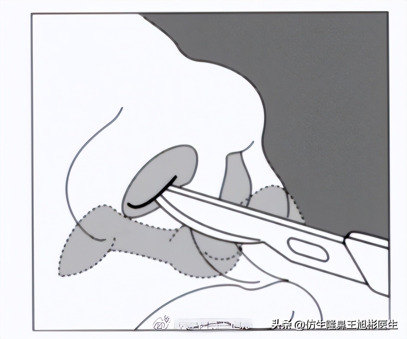 鼻基底填充会移位到鼻孔吗,鼻基底填充假体会拉长人中吗