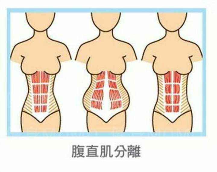 腹直肌分离最有效的恢复方法,产妇腹直肌分离调整