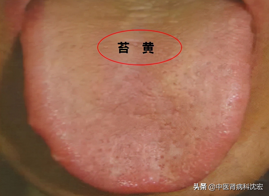 名方左金丸治胃病，只有2味药，胃酸、胃胀、胃痛，悄悄不见