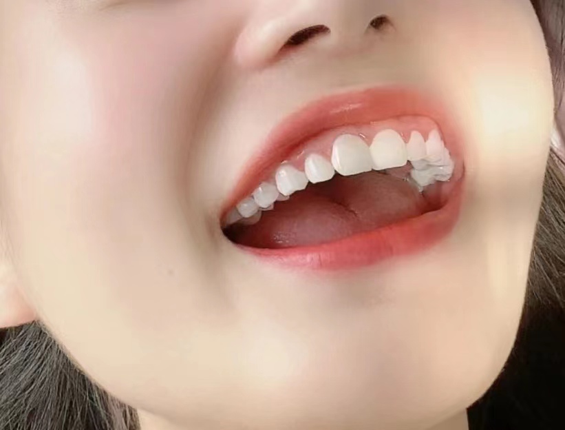 牙缝有牙垢怎么去除,牙缝牙垢又臭又硬怎么去除