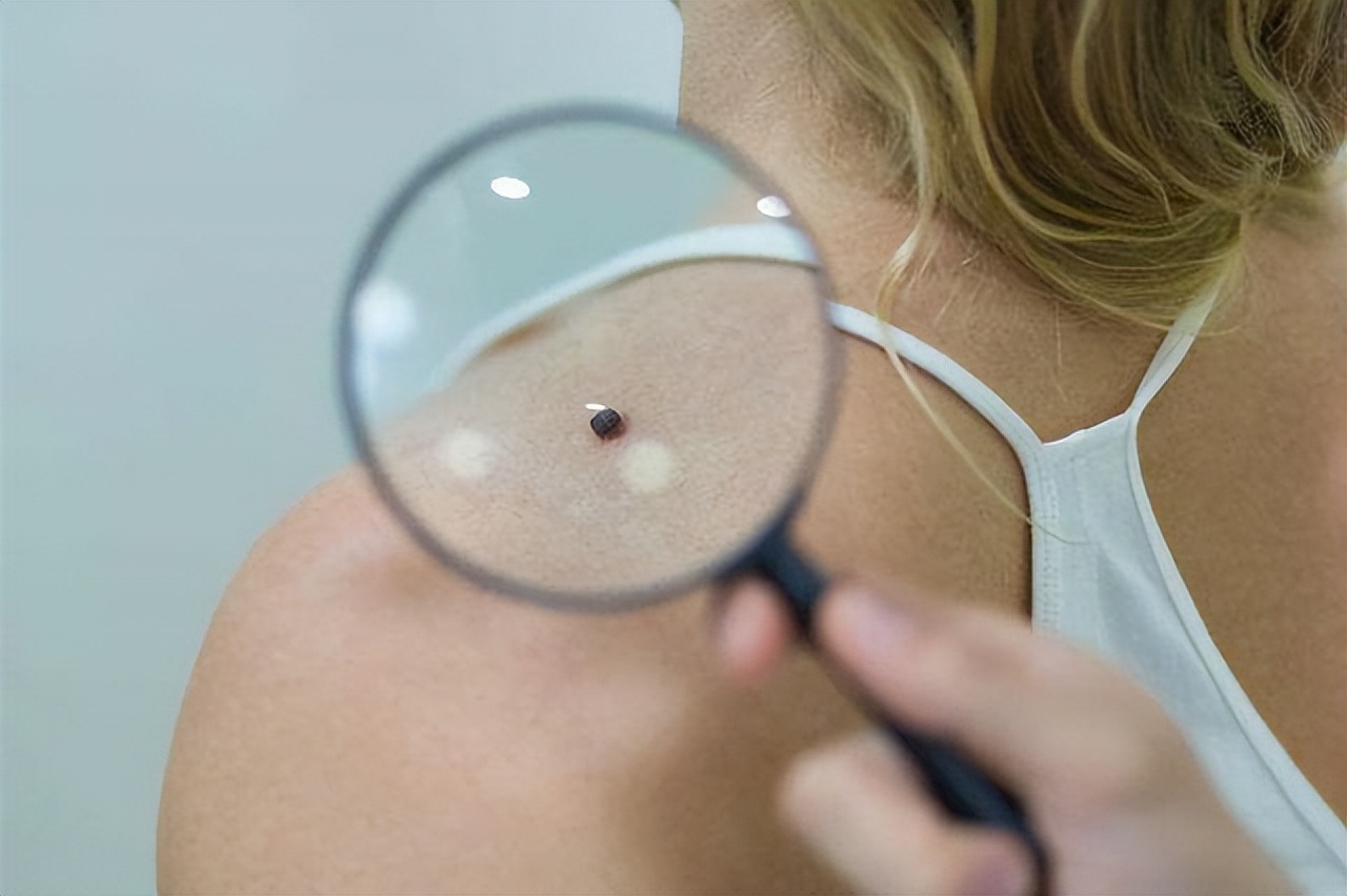 身上长红痣好还是长黑痣好,身上的痣出现这些变化小心会癌变