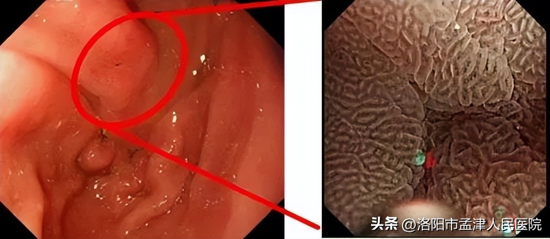 奥林巴斯290内镜系统介绍,奥林巴斯290电子胃肠镜介绍