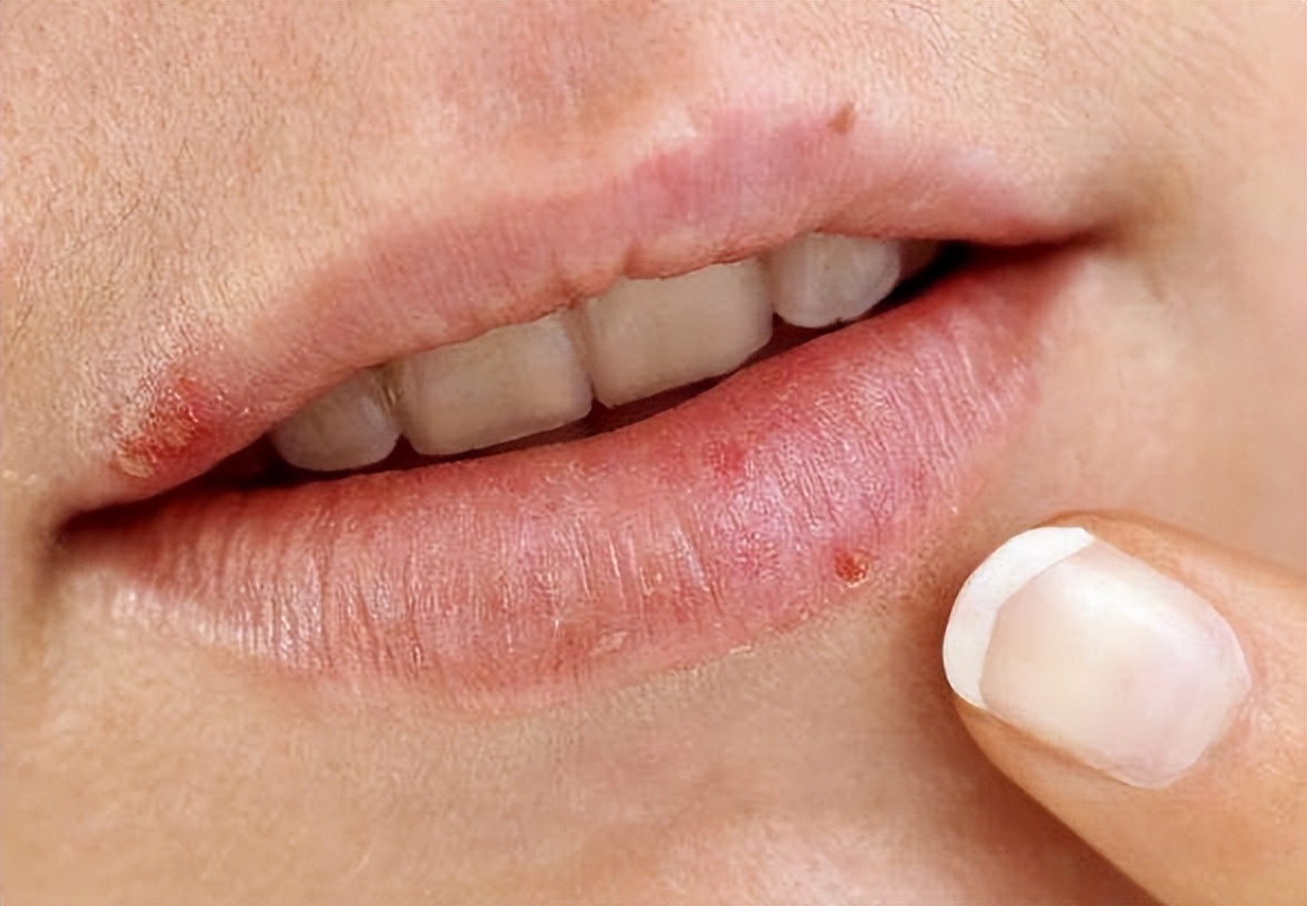 嘴巴周围起一连串的水泡,六岁嘴巴经常起上火的水泡