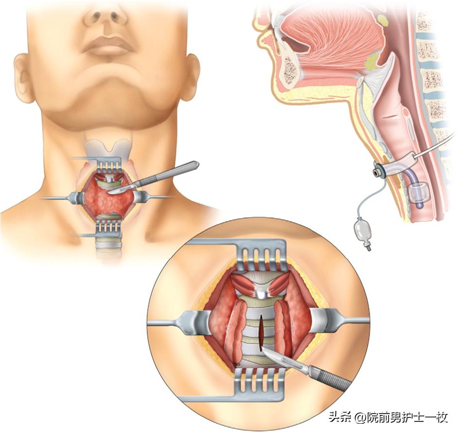 关于气管切开技术流程及注意事项