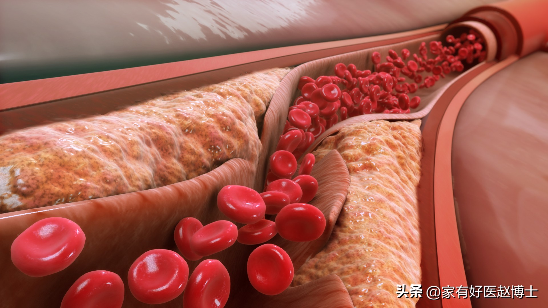 “好胆固醇HDL-C”偏低,用不用吃药提升?最新血脂指南告诉您!