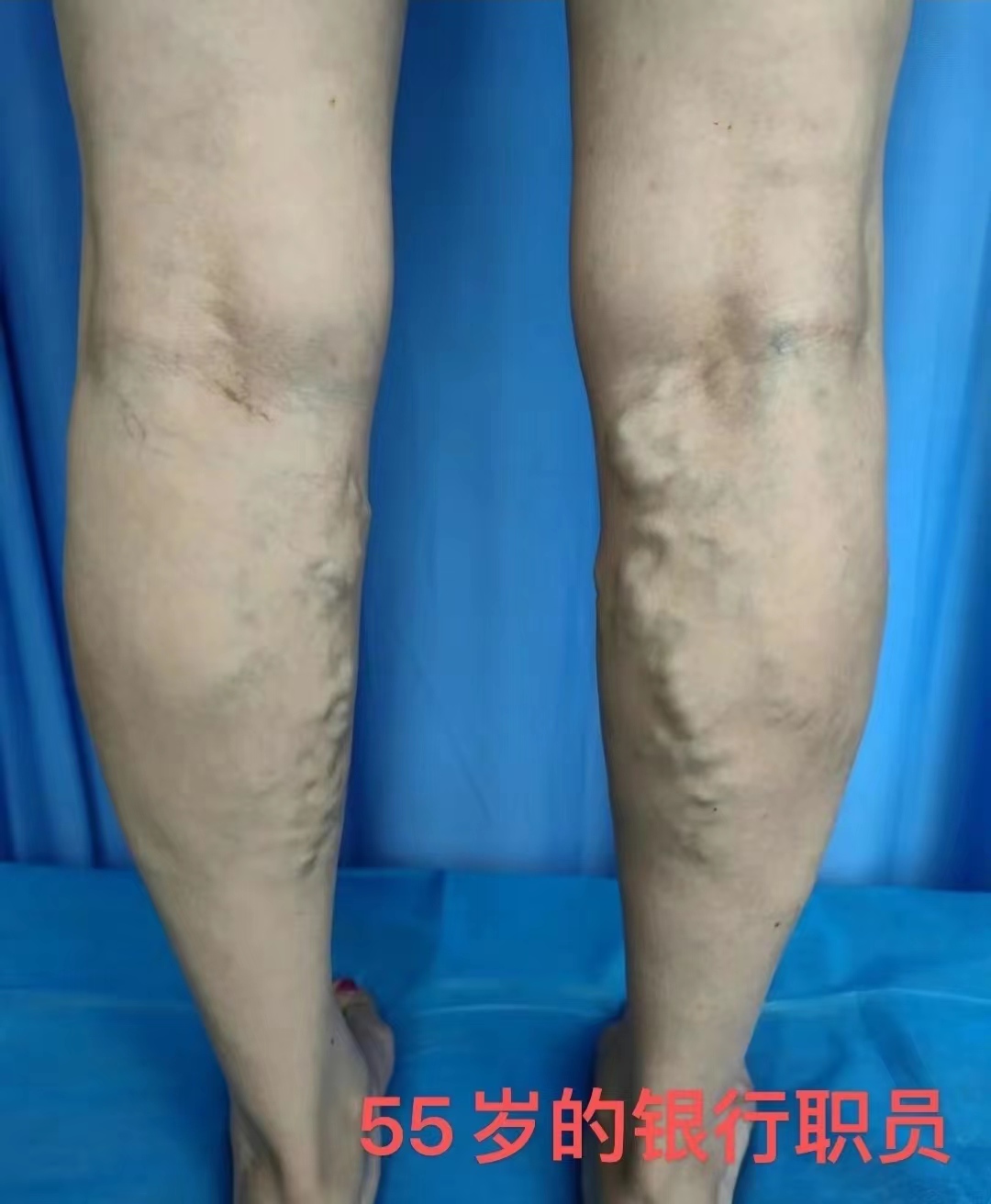 静脉曲张专家杨希亭：早期静脉曲张有哪些方法可以避免症状加重？