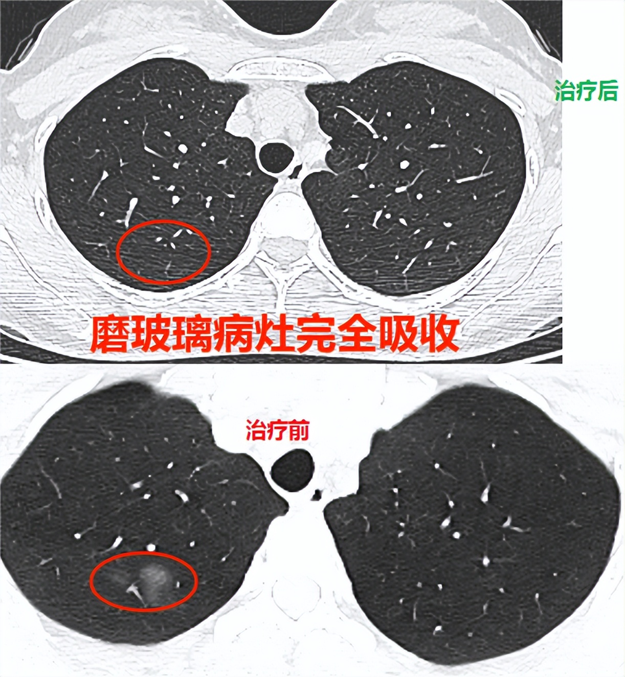 双肺上叶局部肺气肿怎么办,怎么治两肺纹理增多