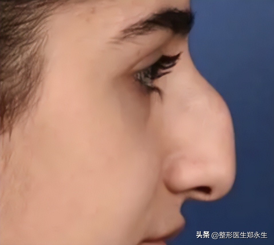 细节决定美丽，鼻尖改善对颜值的重要性，想要做鼻子要认真看