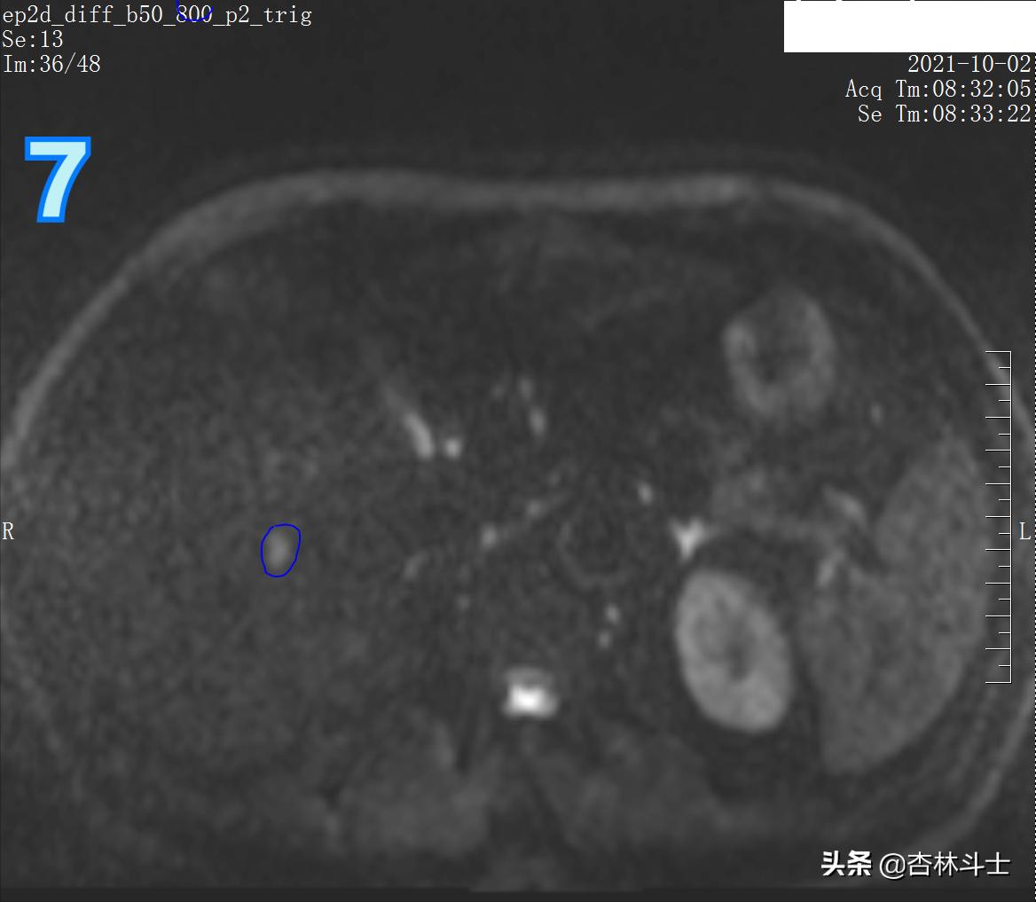 肝癌8公分肿瘤能活多久,肝癌细胞最大长多大