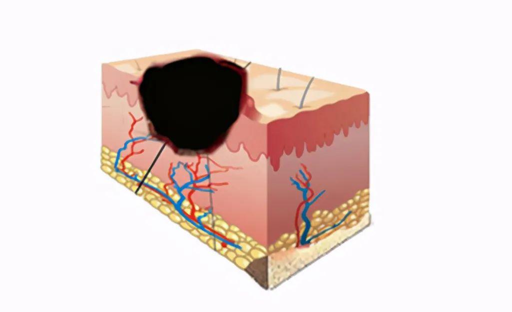 黑痂型褥疮最佳治疗方法,褥疮起黑痂很硬一直不好怎么办