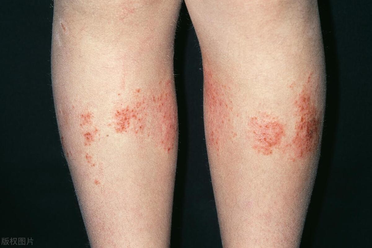 湿气重长湿疹怎么调理夏天特别痒,湿气重长湿疹怎么调理