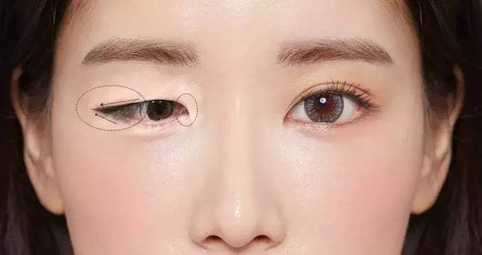 双眼皮的形成原因是什么？如何让单眼皮变成自然的双眼皮？