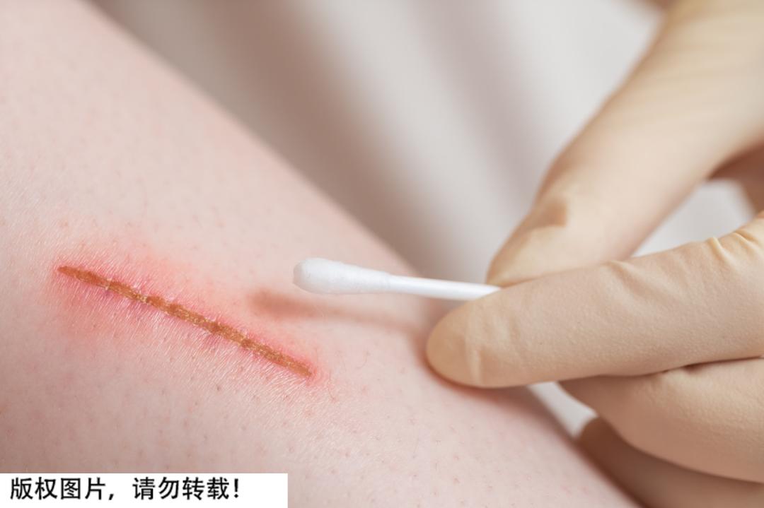 结痂为什么感觉很紧绷,结痂很痒可以抠掉吗